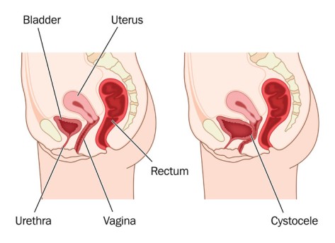 Laparoscopic Cystectomy by OrangeCountySurgeons